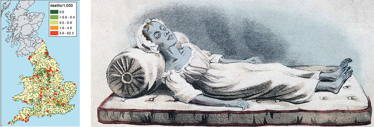 map of cholera in England, 1831-32, and patient with bluish skin